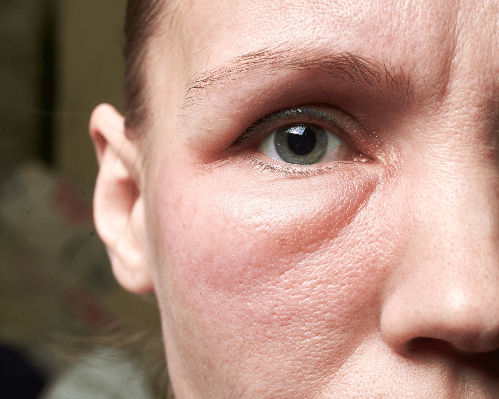 Alcohol face bloat; it's visible effects on our skin (and health)