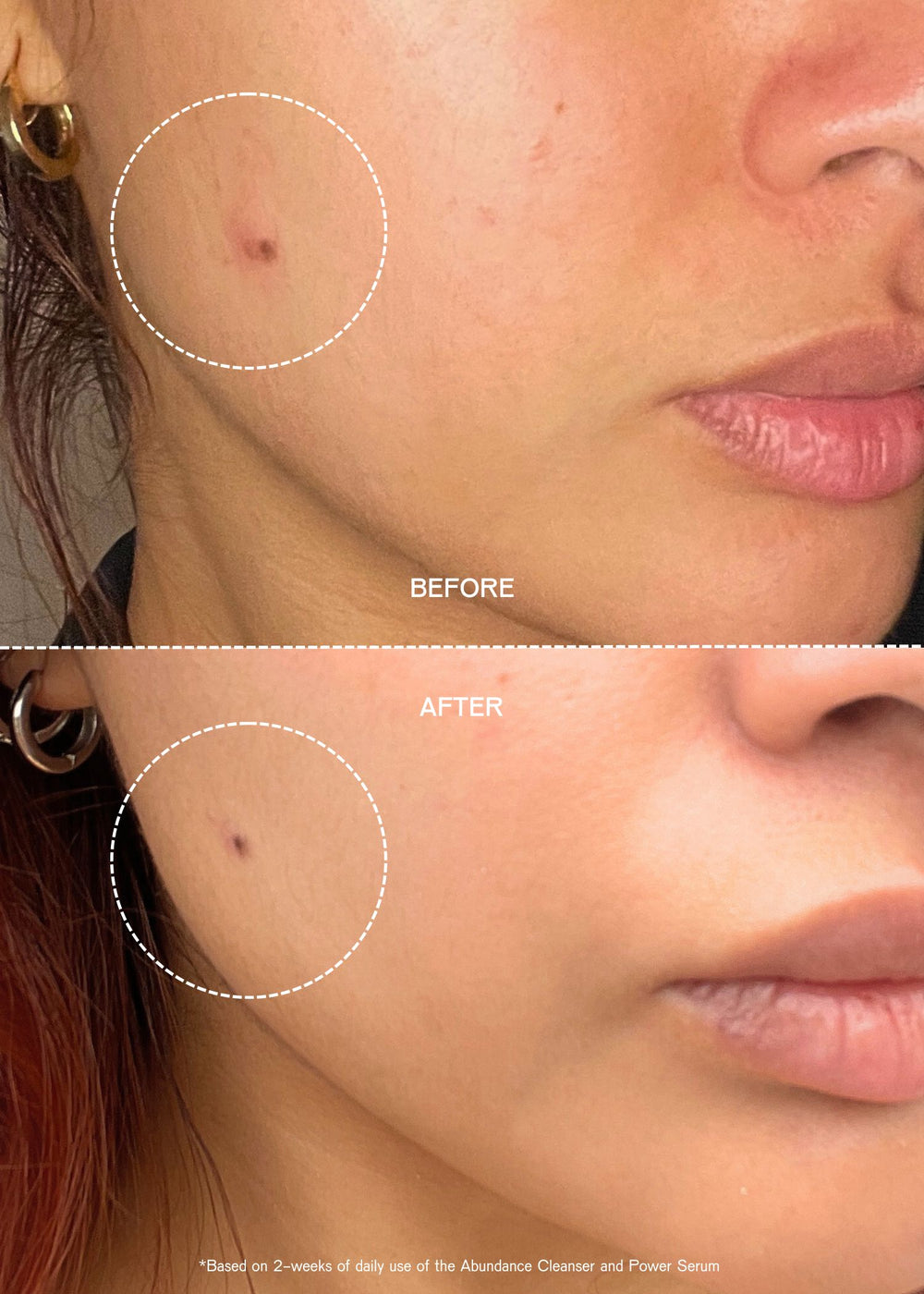 chemical exfoliant before and after 